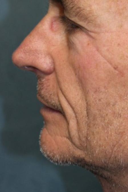 Before image 3 Case #87371 - Hair Transplantation San Diego