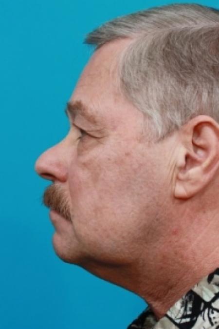 Before image 2 Case #78926 - Upper Blepharoplasty
