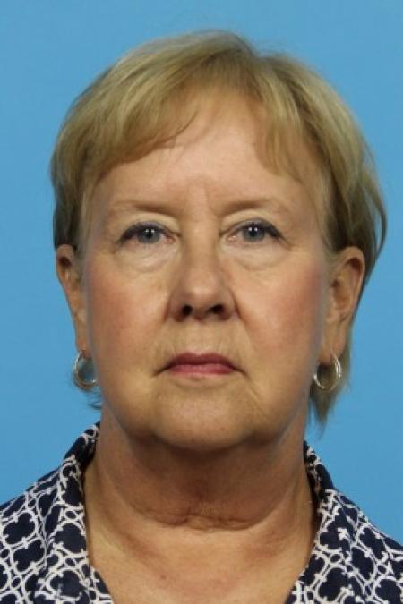 Before image 1 Case #82986 - Full Facial Rejuvenation