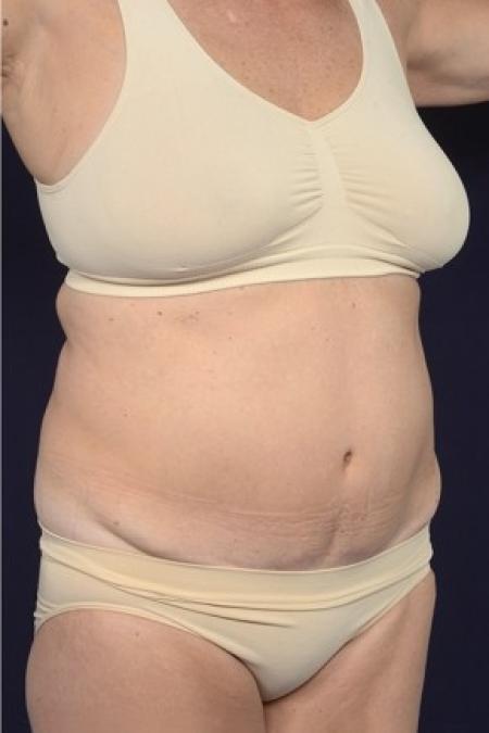 Before image 2 Case #87521 - Trunk Liposuction