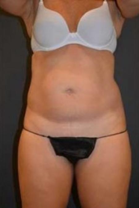 Before image 1 Case #85686 - Tummy Tuck 