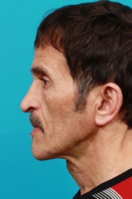 Before image 3 Case #78726 - Face / Neck Lift
