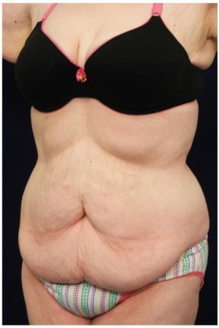 Before image 2 Case #82111 - Tummy Tuck