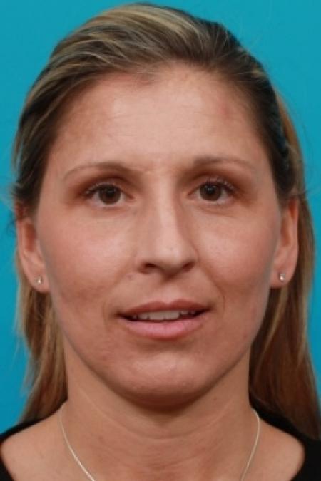 Before image 1 Case #80521 - Open Rhinoplasty