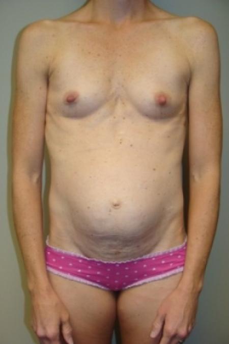 Before image 1 Case #80031 - Mommy Makeover