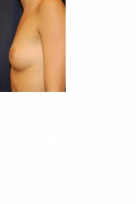 Before image 2 Case #81086 - Breast Augmentation