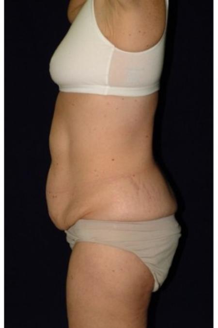 Before image 3 Case #81926 - Mommy Makeover