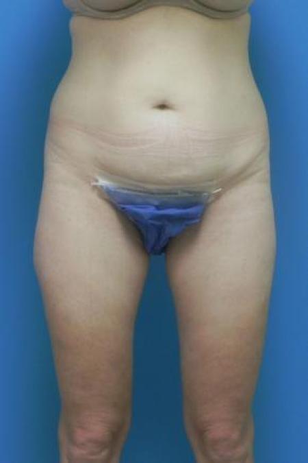 Before image 1 Case #80996 - Abdominoplasty 