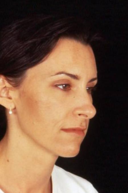 Before image 1 Case #81631 - Rhinoplasty