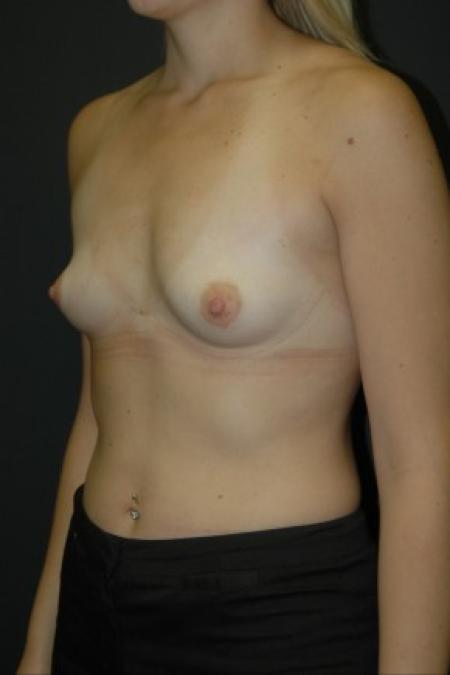Before image 2 Case #81301 - Sientra Breast Augmentation MP-350cc