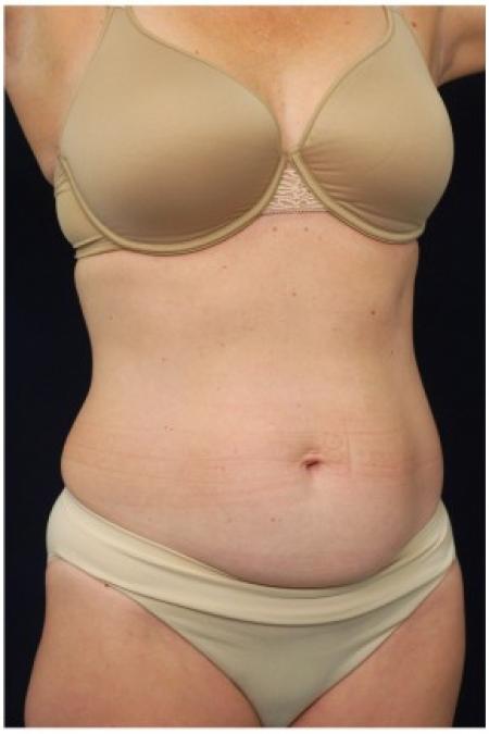 Before image 2 Case #82106 - Tummy Tuck