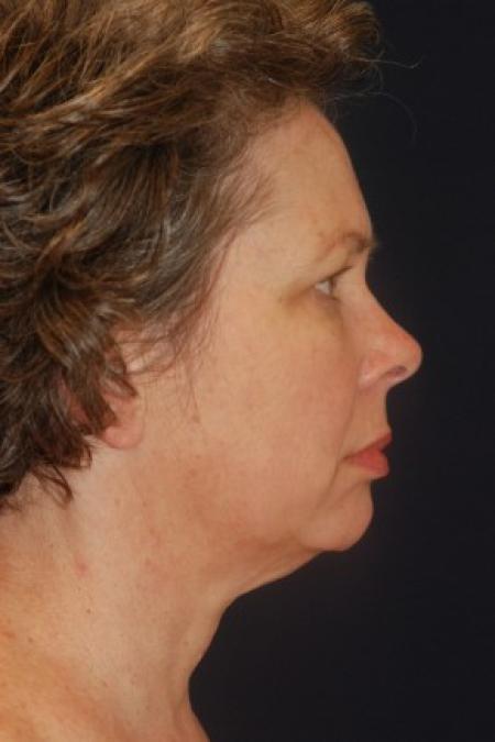 Before image 3 Case #87756 - Full Facial Rejuvenation