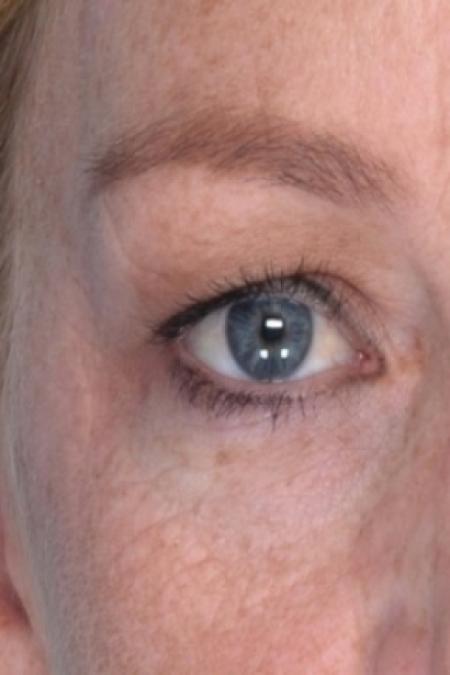 Before image 3 Case #80591 - Eyelid