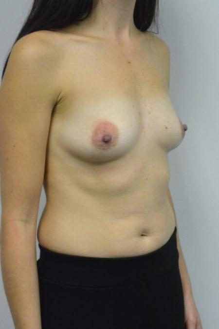 Before image 2 Case #88086 - 34-44 year old woman treated with breast augmentation using Ideal Implants
