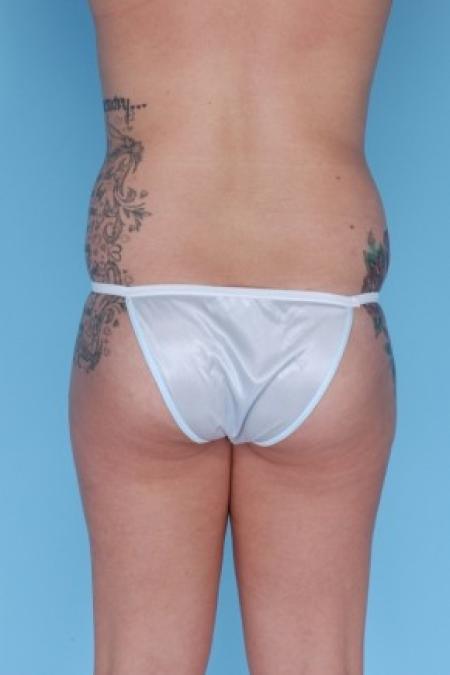 Before image 2 Case #82286 - Liposuction