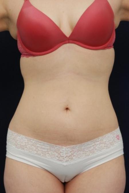 Before image 1 Case #87726 - Liposuction