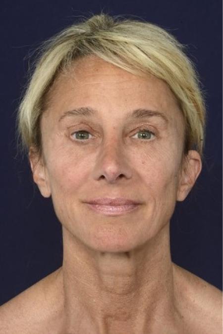 Before image 1 Case #87126 - Structural Fat Grafting
