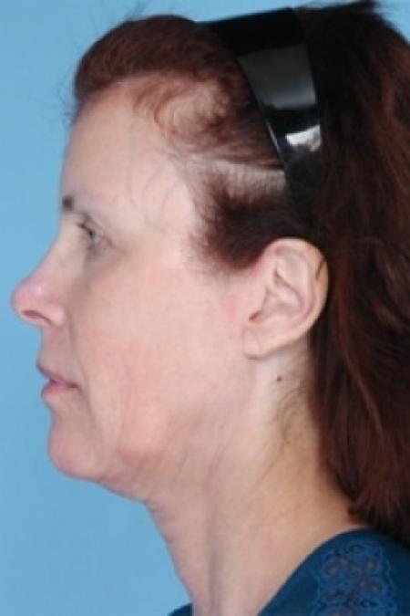 Before image 3 Case #79311 - Non-Surgical Focused Ultrasound