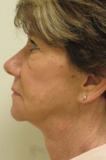 Before Case #82661 - Chemical peel - lids, cheeks and mouth