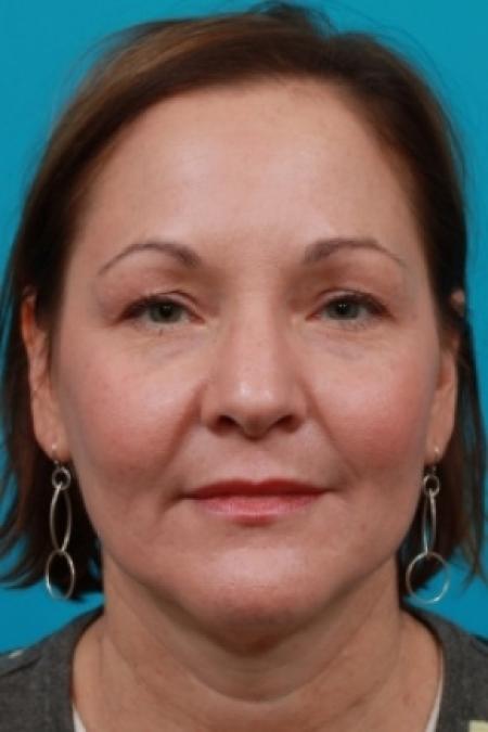 Before image 1 Case #78891 - Upper Blepharoplasty