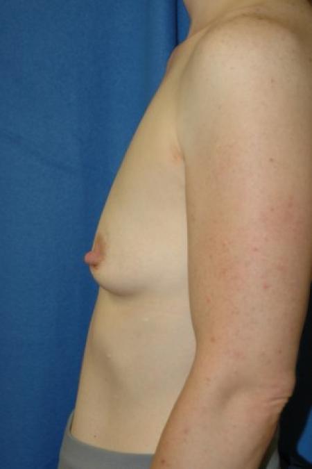 Before image 3 Case #81336 - Breast Augmentation using Allergan Style 410-MF335cc