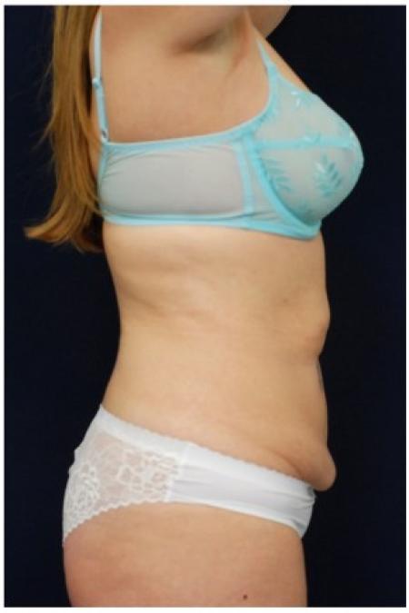 Before image 3 Case #82126 - Tummy Tuck