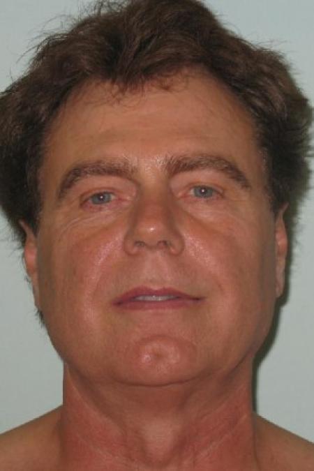 Before image 1 Case #82691 - 65 Year Old Male Facial Rejuvenation