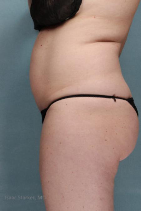 Before image 2 Case #88161 - Tummy Tuck