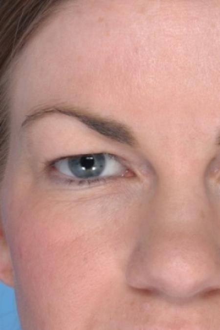 Before image 1 Case #80586 - Upper Blepharoplasty