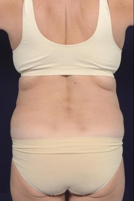 Before image 4 Case #87521 - Trunk Liposuction
