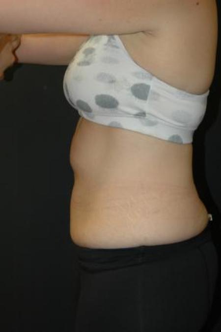 Before image 2 Case #80891 - Coolsculpting Procedure on Upper Abdomen