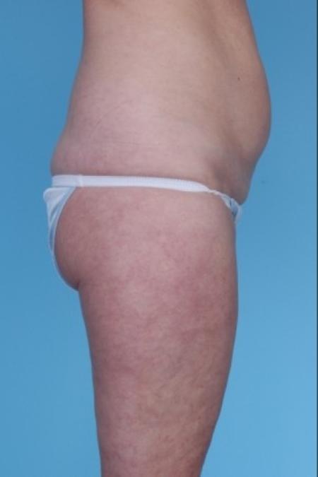 Before image 1 Case #82281 - Liposuction