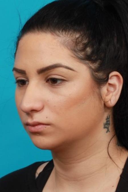 Before image 2 Case #83921 - Rhinoplasty with Chin Augmentation