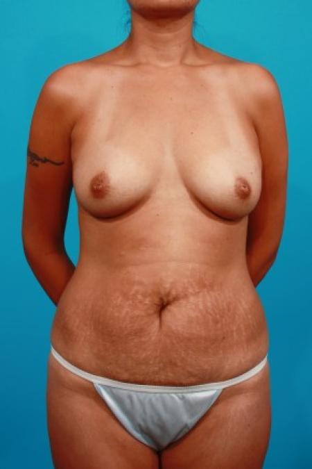 Before image 1 Case #84006 - Mommy Makeover: TT / BA / SAL