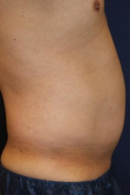 Before image 3 Case #80846 - Liposuction