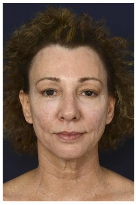 Before image 1 Case #86276 - 50 year old woman treated with Full Facial Rejuvenation