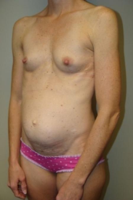 Before image 3 Case #80031 - Mommy Makeover