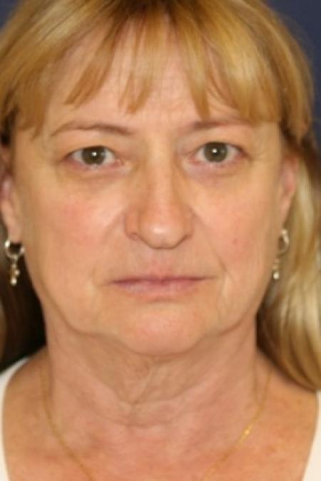 Before image 1 Case #81076 - Nose Reshaping