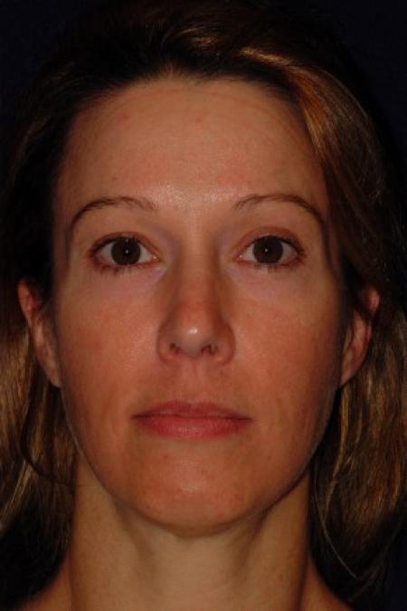 Before image 1 Case #87661 - Full Facial Rejuvenation