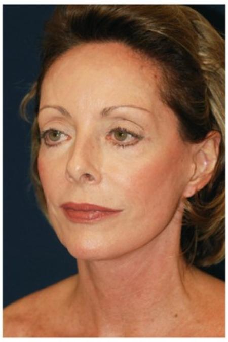 Before image 2 Case #82041 - Full Facial Rejuvenation