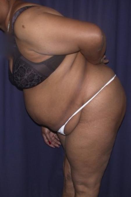 Before image 2 Case #82201 - LipoAbdominoplasty