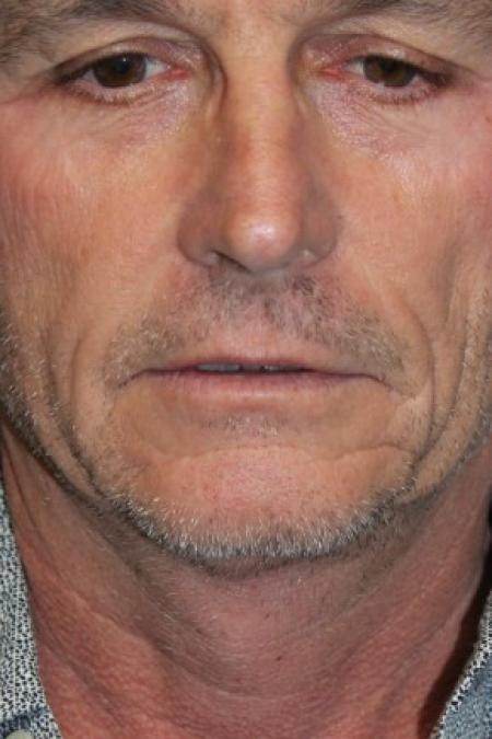Before image 1 Case #87371 - Hair Transplantation San Diego