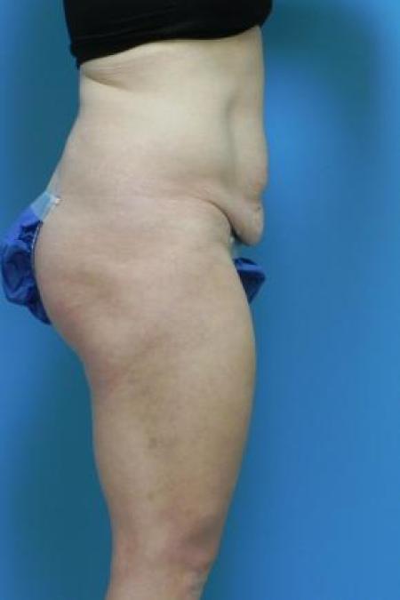 Before image 2 Case #80986 - Abdominoplasty 