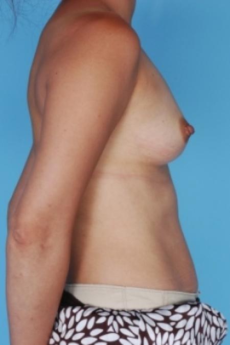 Before image 3 Case #80551 - Breast Augmentation