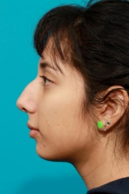 Before image 3 Case #78761 - Rhinoplasty (Nose Reshaping)