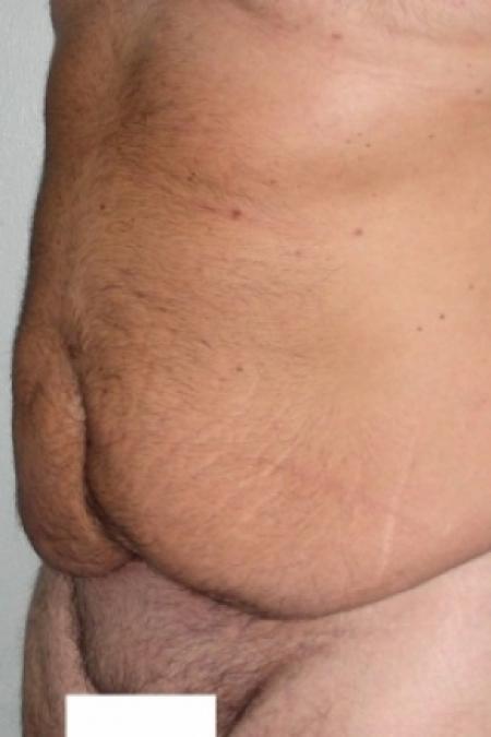 Before image 2 Case #79796 - Male Tummy Tuck