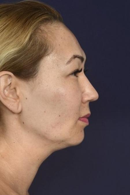Before image 3 Case #87151 - Neck / Chin Liposuction