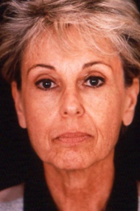 Before image 1 Case #81501 - Facelift