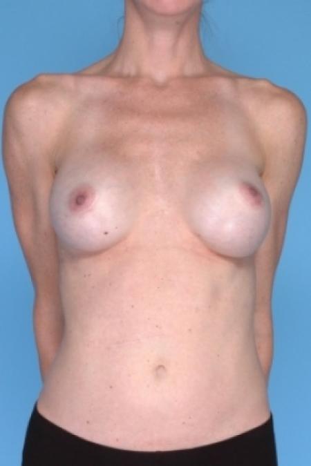 Before image 1 Case #80566 - Breast Augmentation