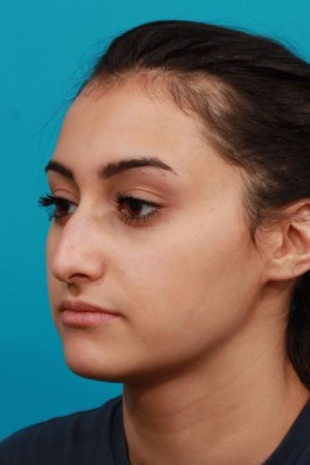 Before image 2 Case #85716 - Open Septorhinoplasty